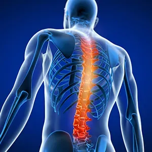 Spine Fusion